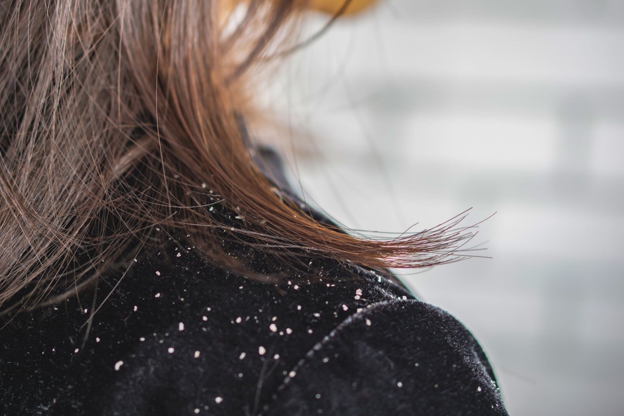 A woman with dandruff